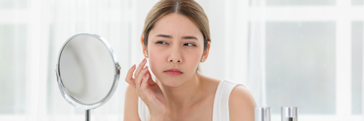 What are the topical treatments for acne?